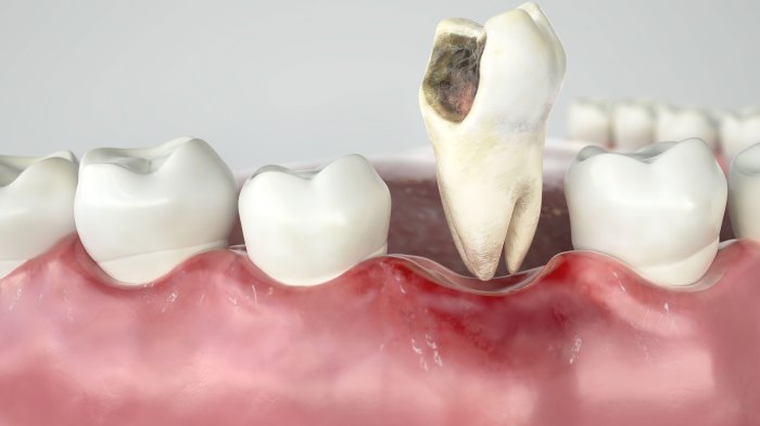 Postsurgical instructions following tooth extraction include which statements